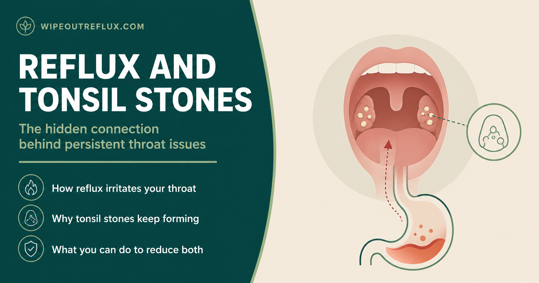 acid reflux and tonsil stones