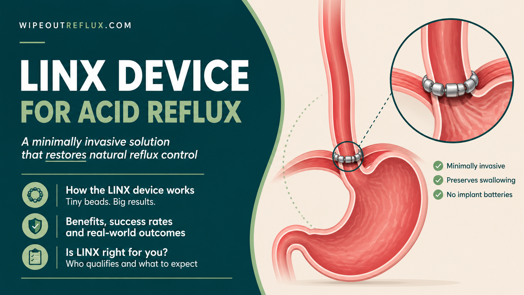 LINX Device for Acid Reflux: How It Works