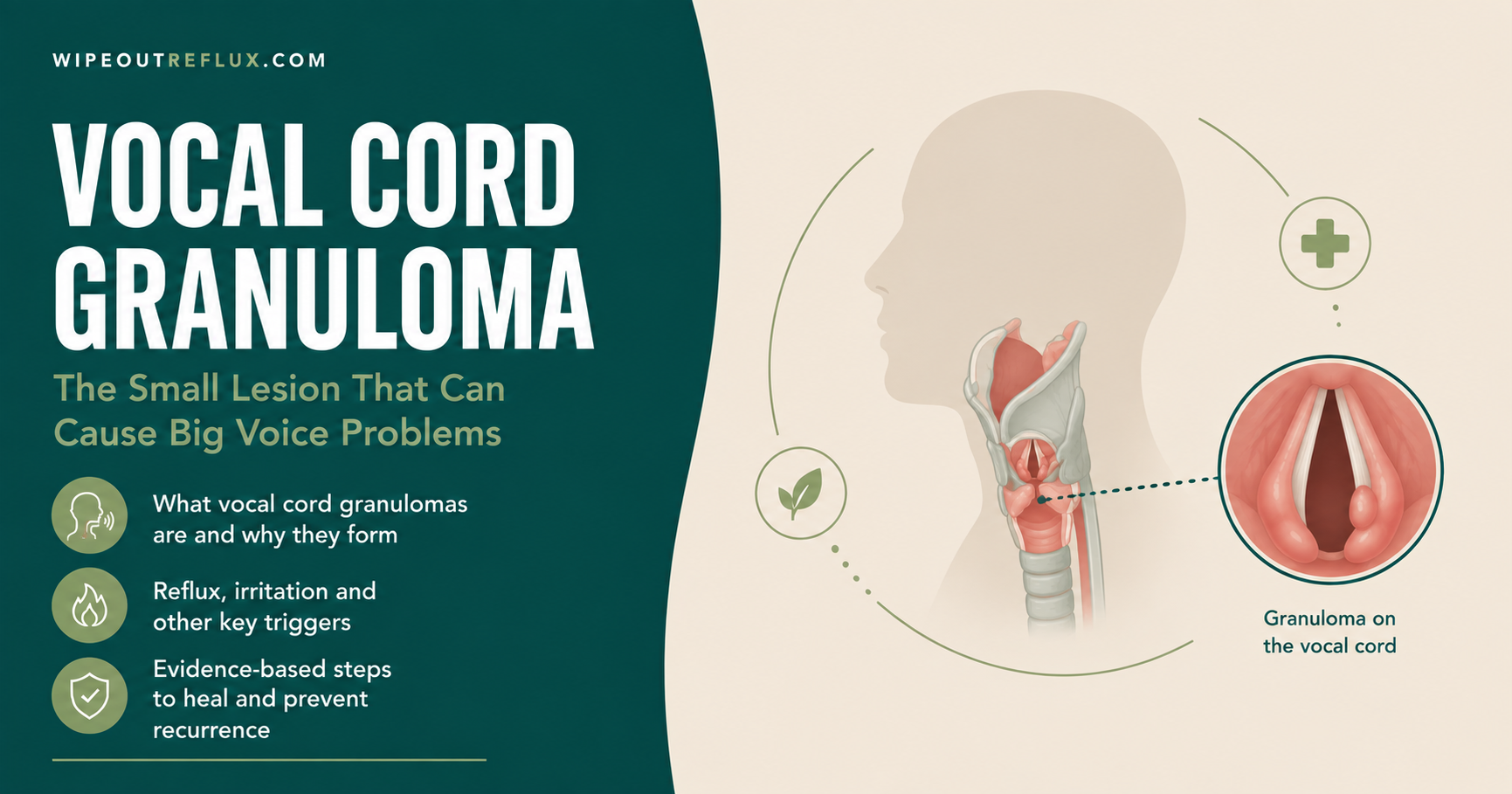 Vocal cord granuloma